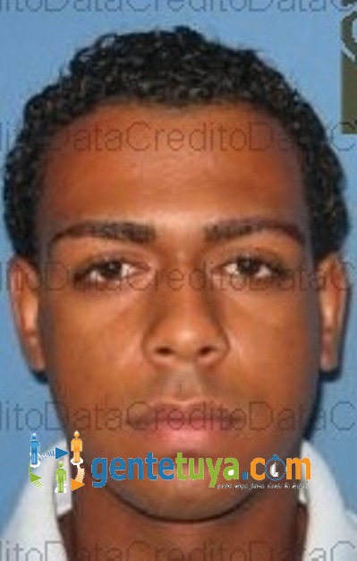 joven calcinado